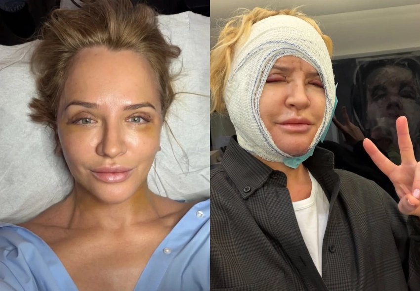 Виктория Шелягова сделала пластическую операцию на лице